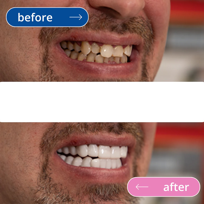 لمینت دندان دو فک مدل TruSmile (اورجینال)