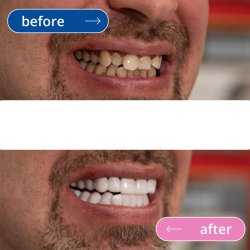 لمینت دندان دو فک مدل TruSmile (اورجینال)